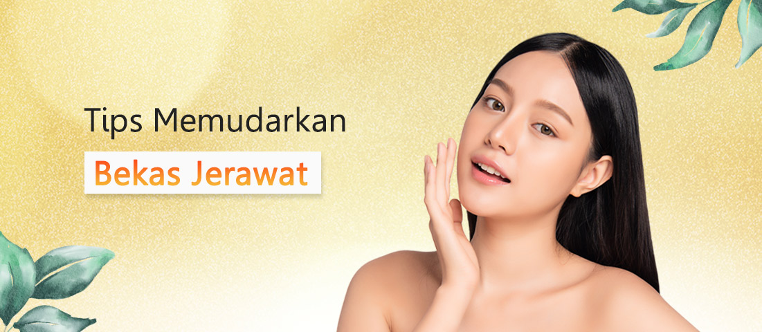 TIPS MEMUDARKAN BEKAS JERAWAT